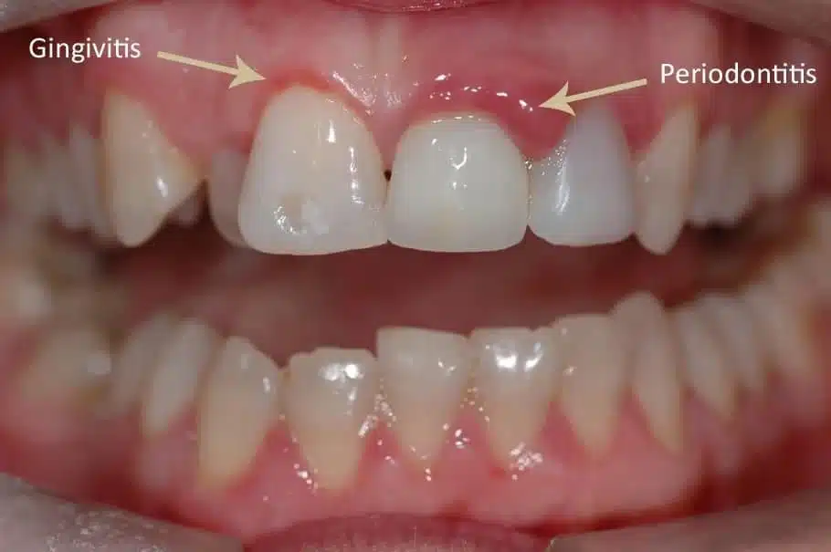 Gingival Diseases SN Clinic | عيادة سن