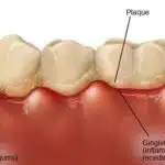 Gingival diseases