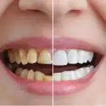 Teeth Whitening