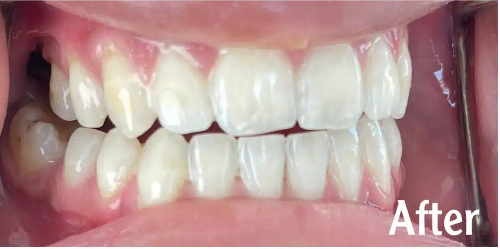 Brighten Your Smile with Professional Teeth Whitening in Kuwait SN Clinic | عيادة سن