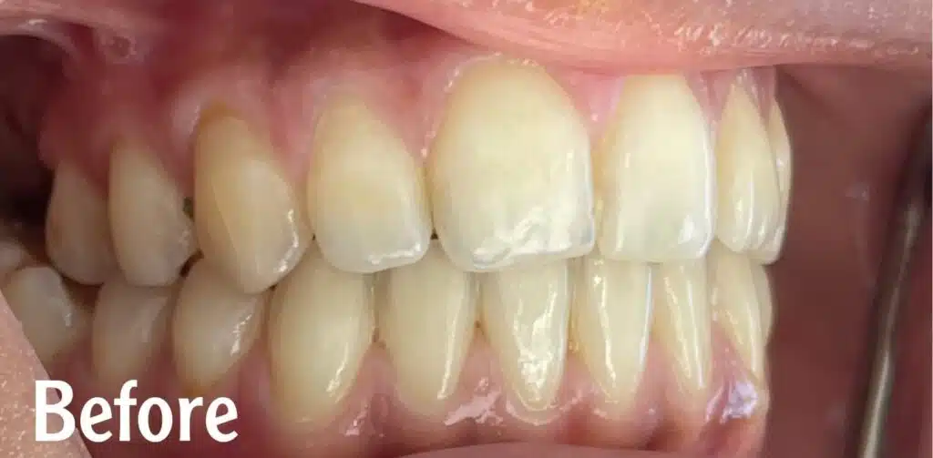Brighten Your Smile with Professional Teeth Whitening in Kuwait SN Clinic | عيادة سن