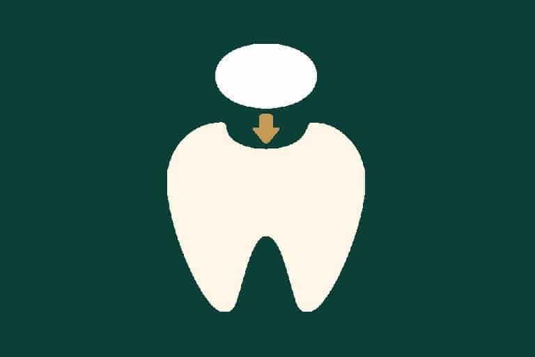 Dental fillings 1 Dental fillings