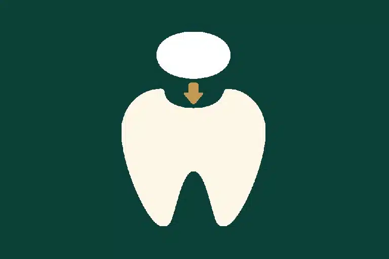 Dental fillings 1 Dental fillings